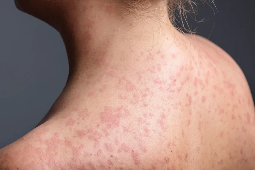 Primary school children in the UK during measles outbreak warning